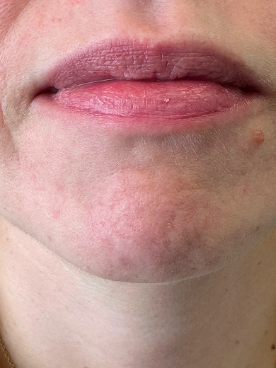 img casos exito acne after 390x520