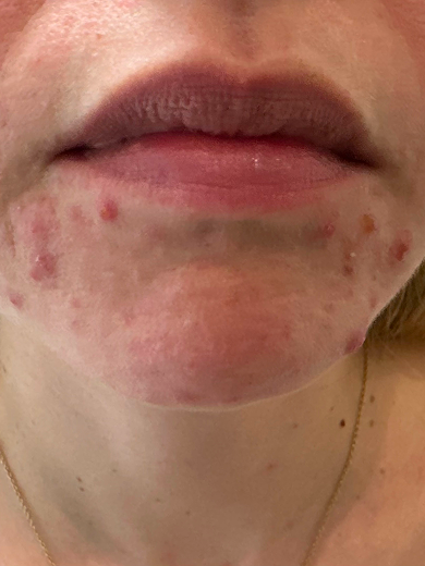 img casos exito acne before 390x520