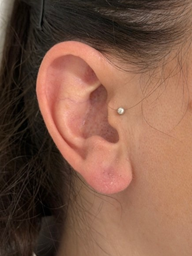 img casos exito agujero oreja after