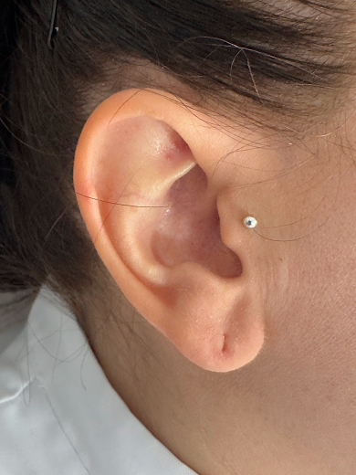 img casos exito agujero oreja before 390x520