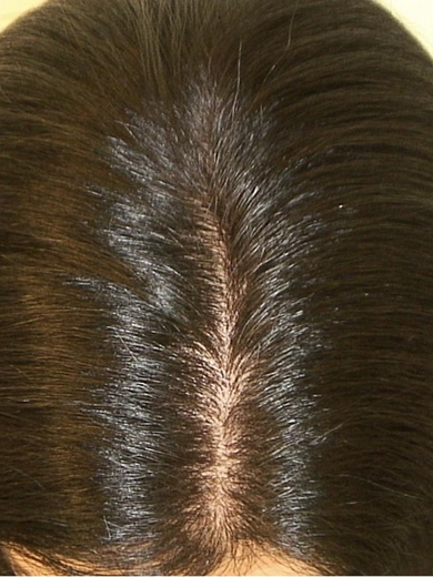 img casos exito alopecia androgenia after 390x520