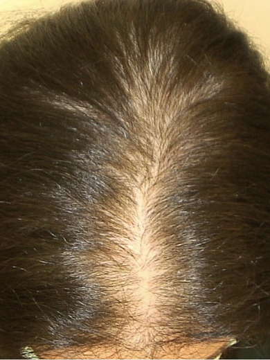 img casos exito alopecia androgenia before 390x520