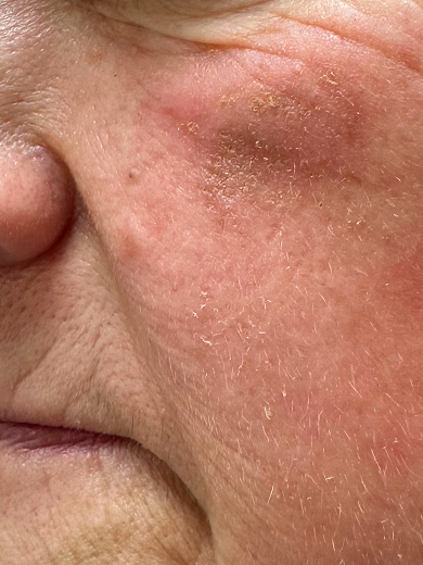 img casos exito mancha after 390x520