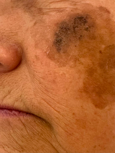 img casos exito mancha before 390x520