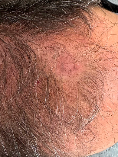 img casos exito queratosis after