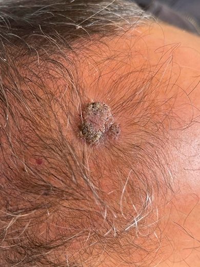 img casos exito queratosis before