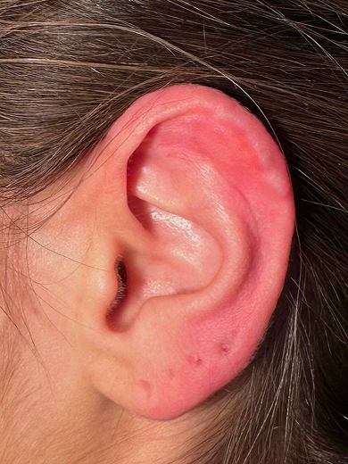 img casos exito remodelacion oreja after 390x520